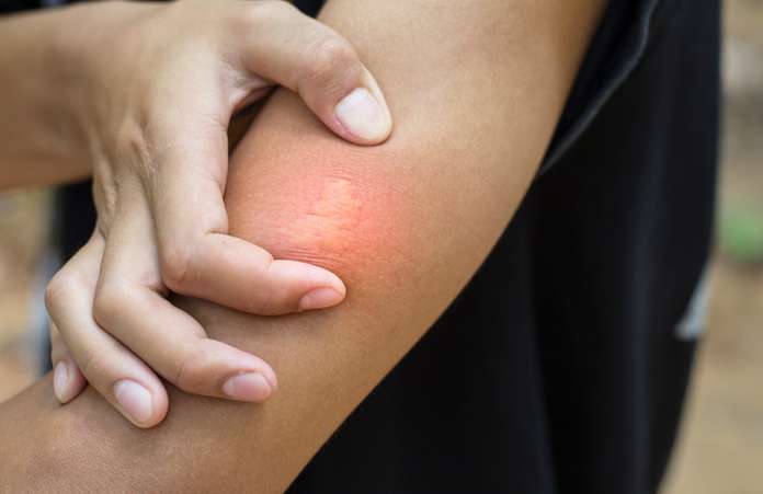 Bee sting in human skin
